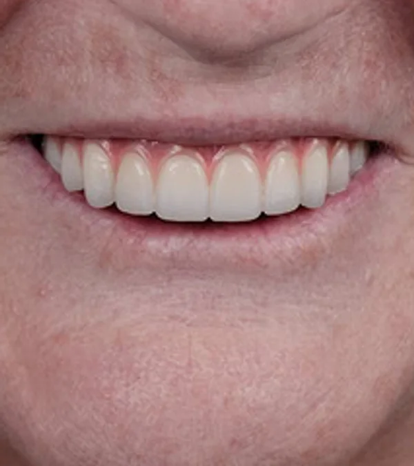 The same patient's smile after All-on-X treatment: a full arch of even, natural-looking implant teeth