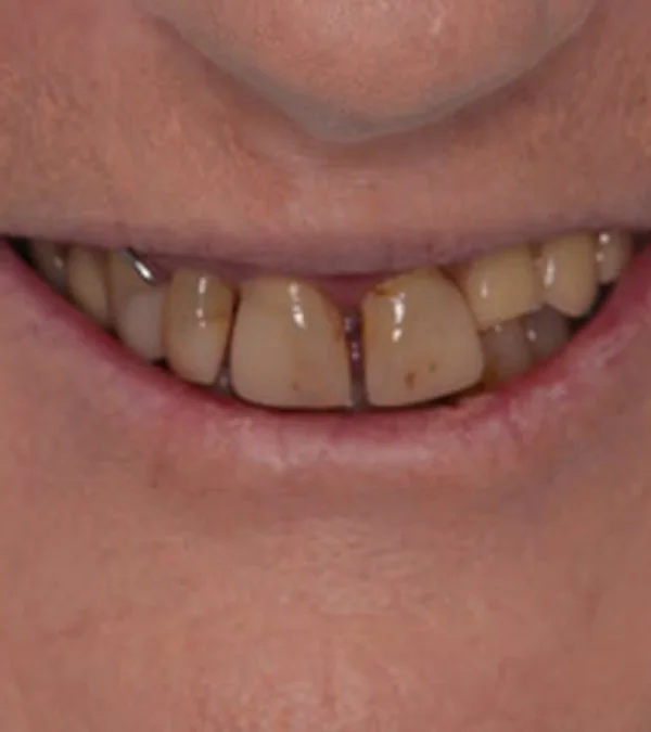 A patient's smile before treatment: worn, discoloured, failing upper teeth