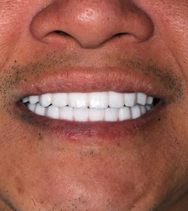 The same patient's smile after treatment: a brighter, even smile