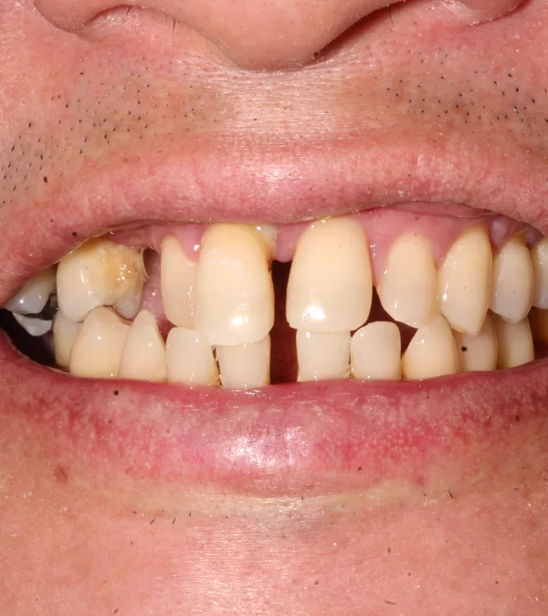 A patient's smile before treatment: crowded, discoloured, gappy teeth