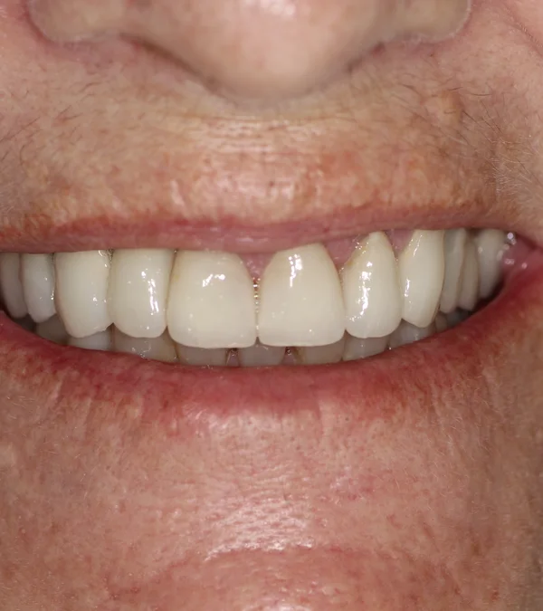 The same patient's smile after treatment: an even, natural-looking smile