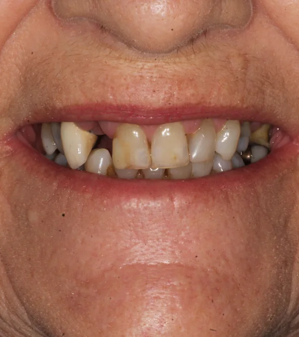 A patient's smile before treatment: worn, gappy, discoloured teeth