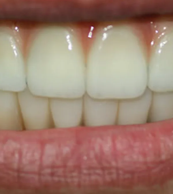 The same patient's smile after dental implant treatment: a complete, even smile