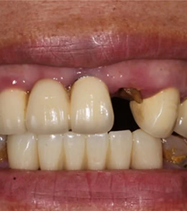 A patient's smile before treatment: a missing front tooth and worn, stained teeth