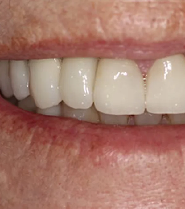 The same patient's smile after dental implant treatment: a natural, complete smile