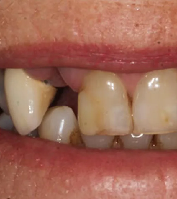 A patient's smile before treatment: a missing upper tooth beside discoloured front teeth