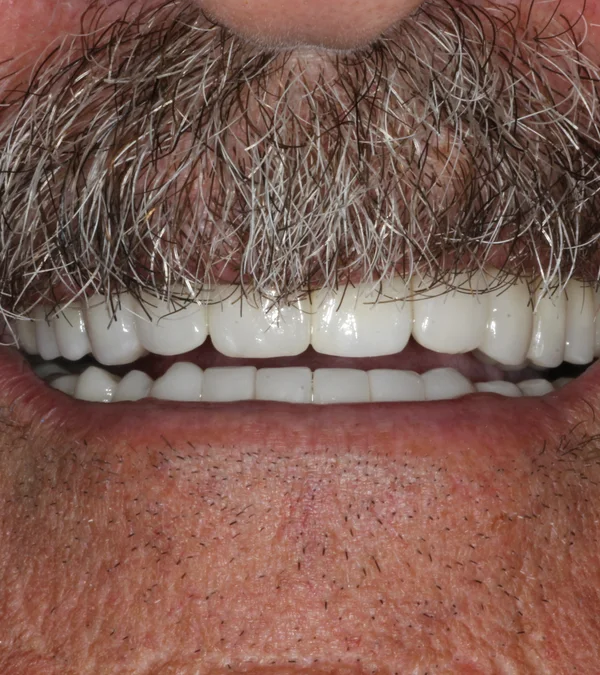 The same patient's smile after treatment: a full, even, restored smile