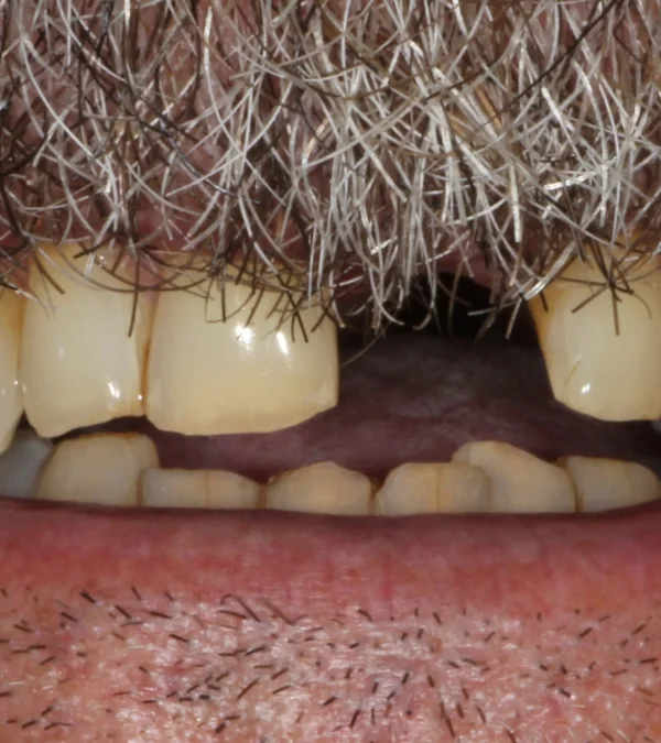 A patient's smile before treatment: missing and broken upper teeth