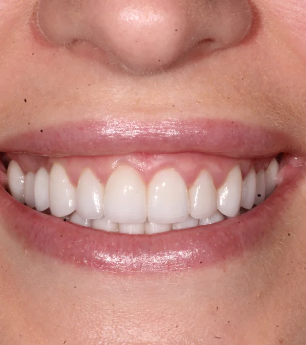 The same patient's smile after treatment: a straighter, even smile