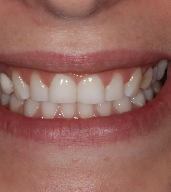 A patient's smile before treatment: crowded, rotated teeth