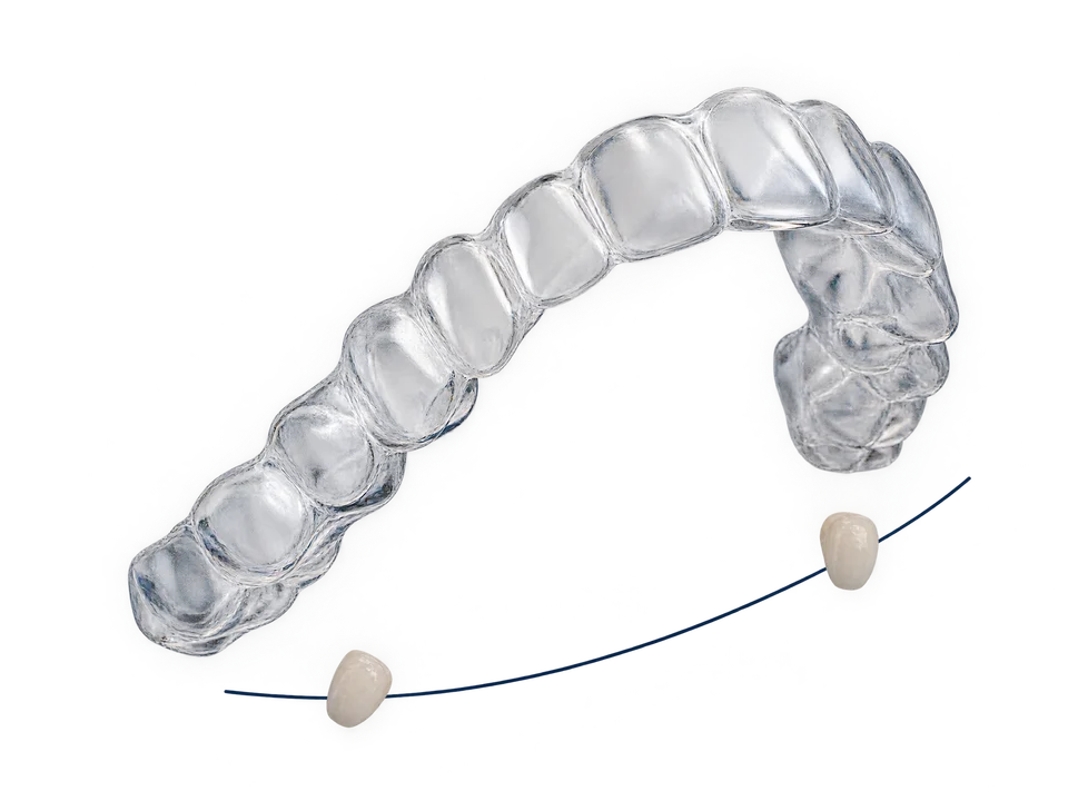 A clear dental aligner above a curved guide line.