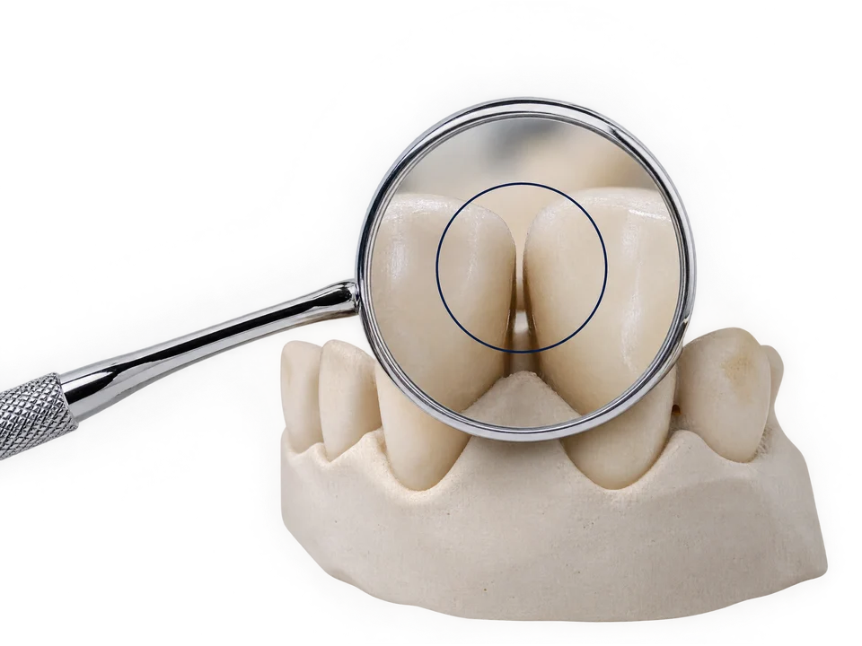 An inspection mirror examining a gap in a dental model.