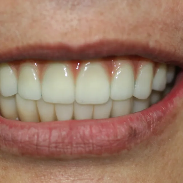 A bright, healthy smile after treatment at Enhanced Dental Studios.