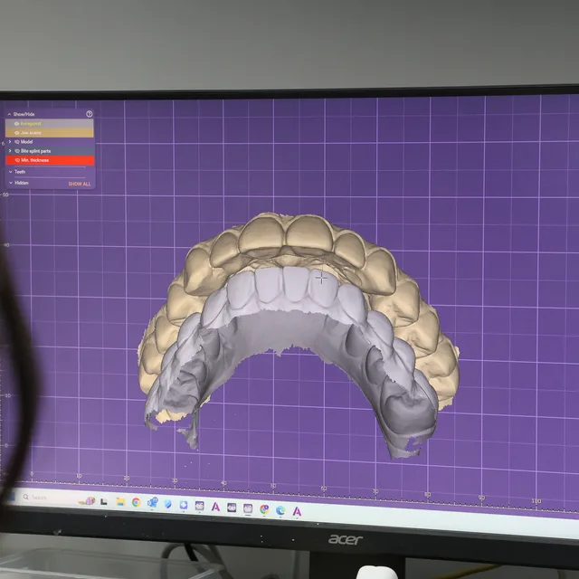 A new tooth being designed on screen in the Enhanced Dental Studios lab.