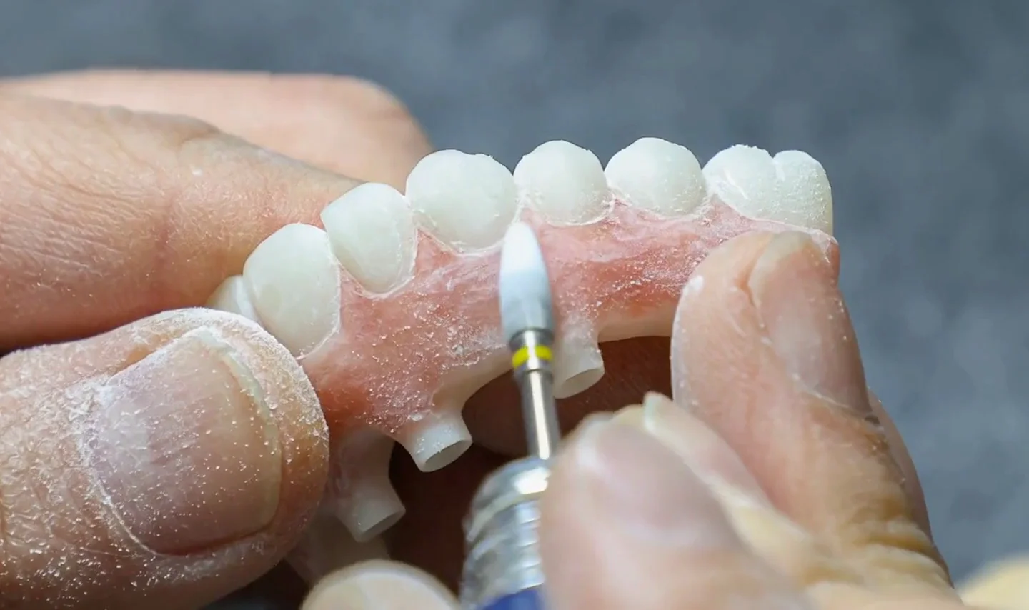Cosmetic Veneers at Enhanced Dental Studios.