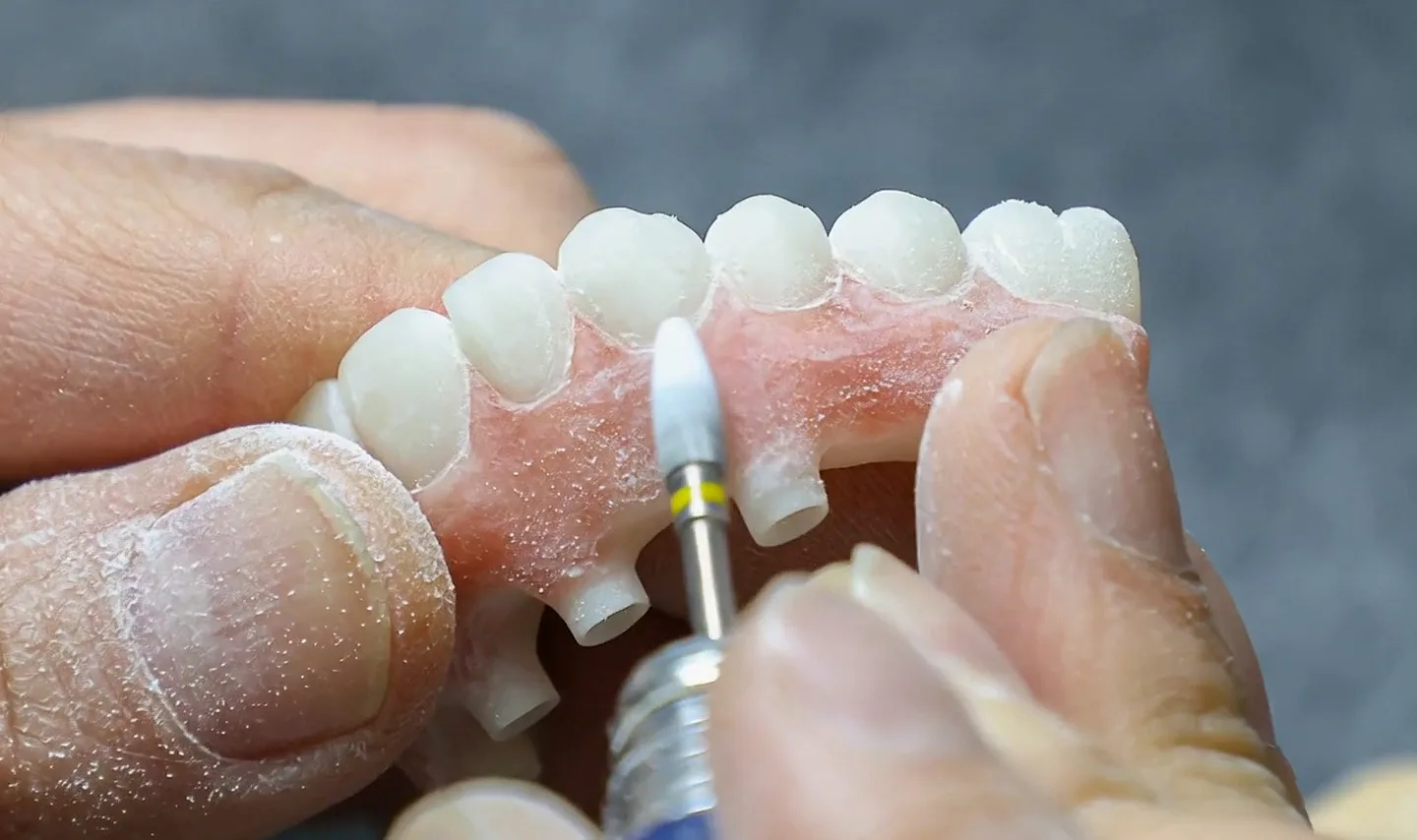 Cosmetic Veneers at Enhanced Dental Studios.