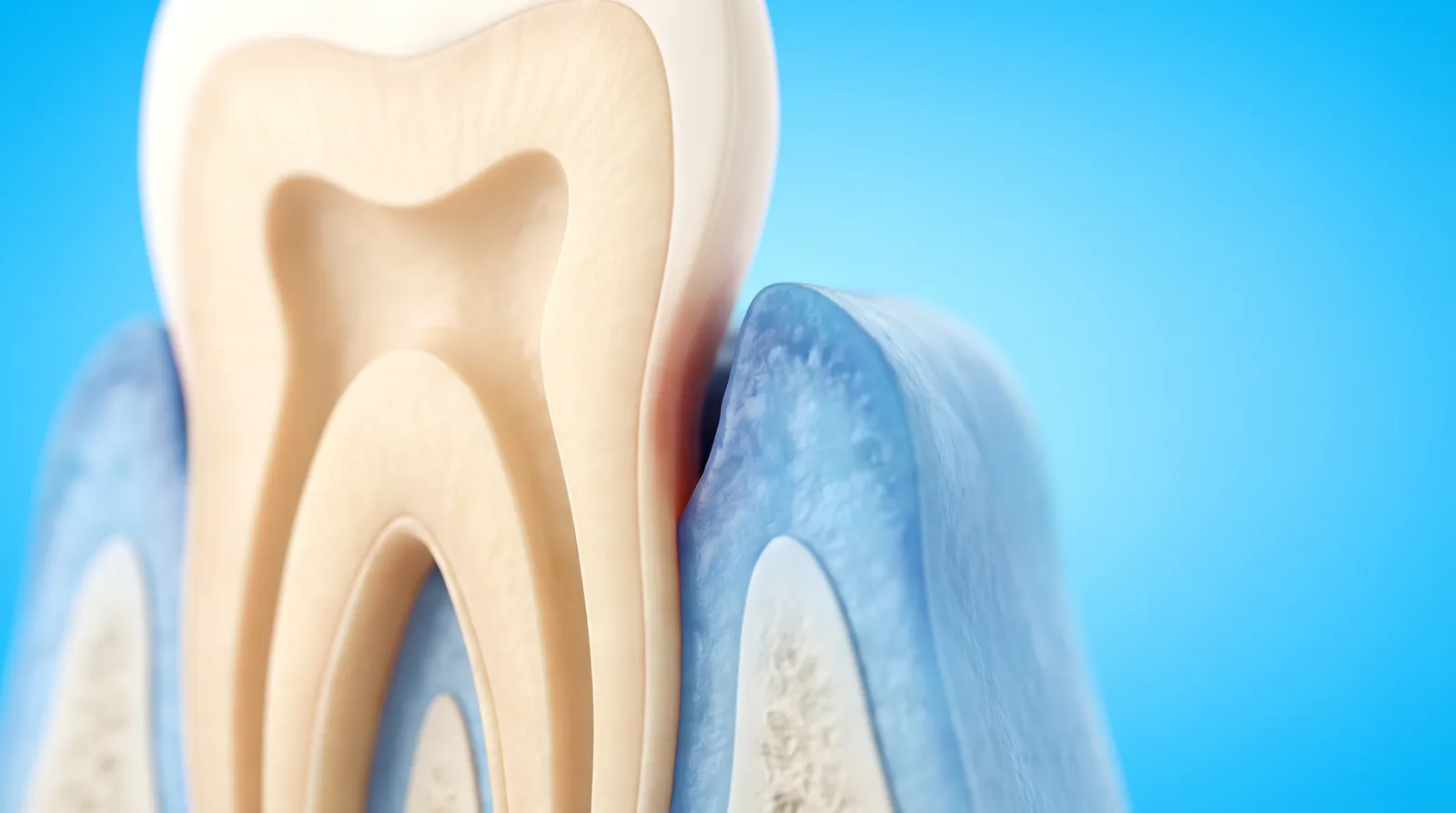 A cut-through showing a deep narrow pocket between a gum and the side of a tooth root