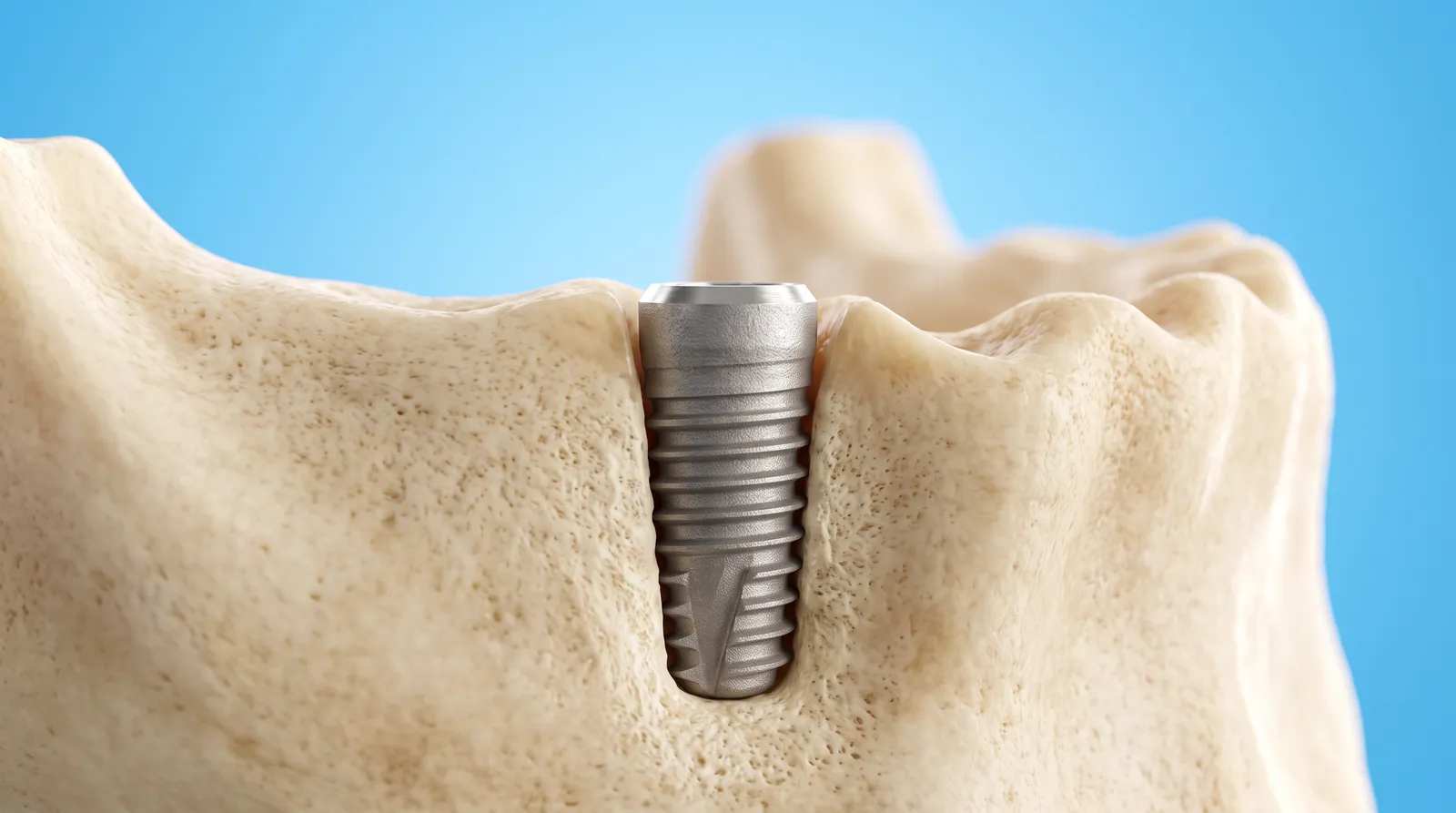 A titanium implant post seated firmly in a rebuilt full ridge of bone
