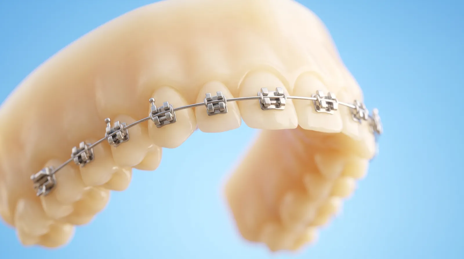 A dental arch with brackets and a continuous archwire threaded through all of them