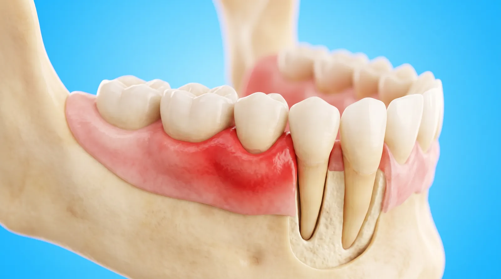 A cut-through gum model with one section swollen and red along the tooth