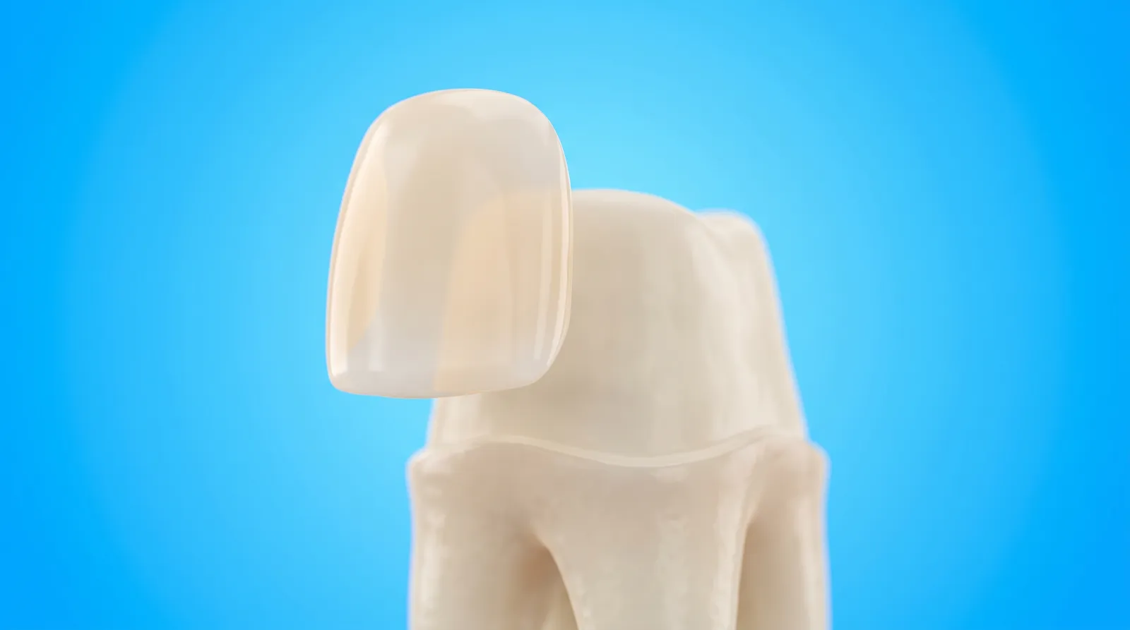 A porcelain veneer shell being placed over the entire front surface of a tooth