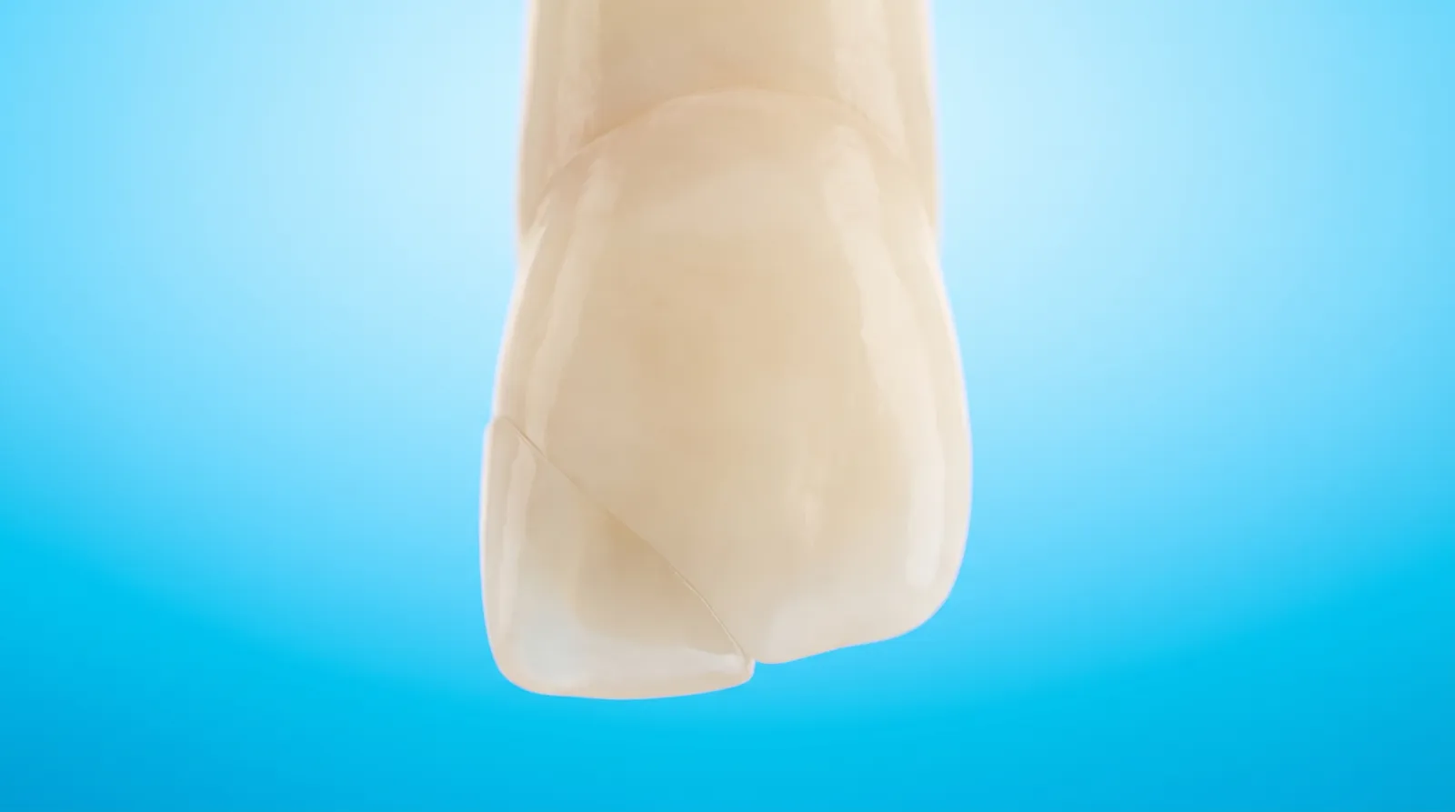 A single front tooth with its missing corner rebuilt seamlessly in matching tooth coloured material
