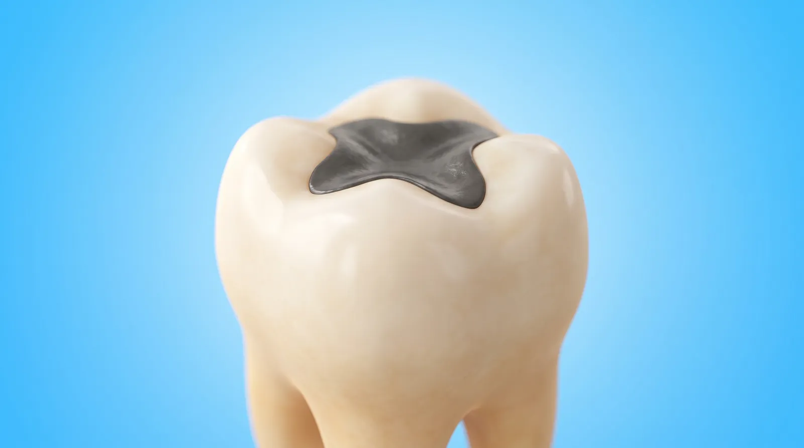 One molar model with a large dark filling set into its biting surface