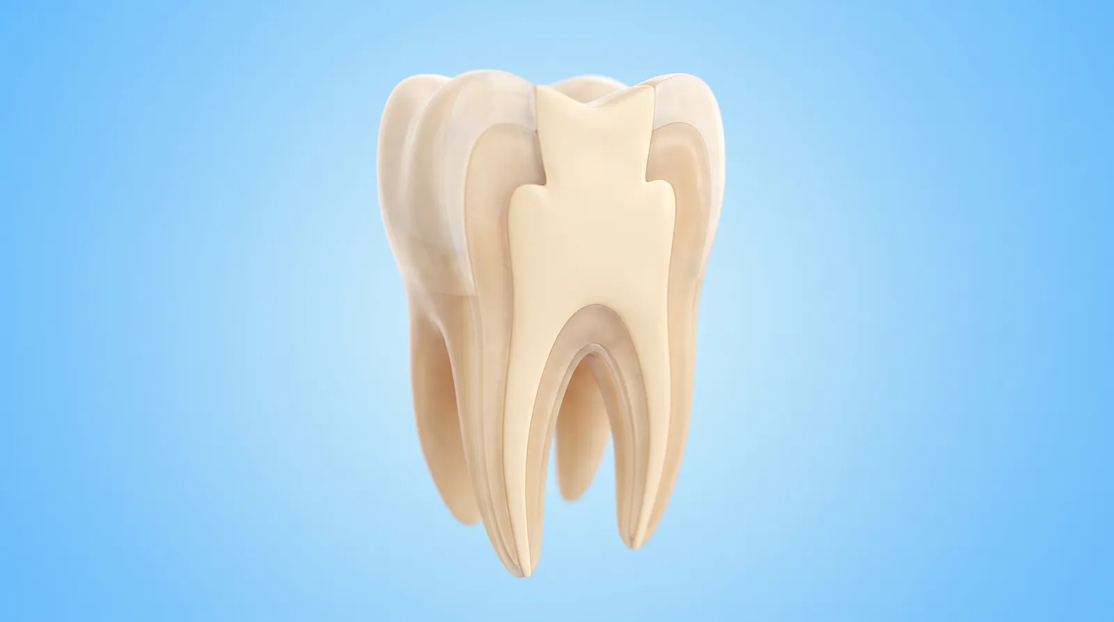 A cut-through molar showing the filling occupying most of the inside of the tooth
