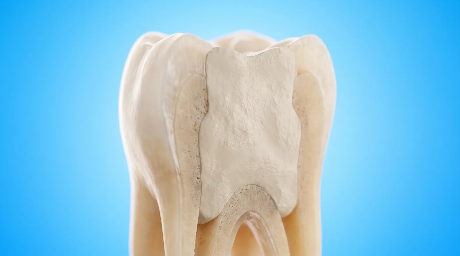 A cut-through molar whose thin fragile outer walls stand around a filling that fills the whole centre