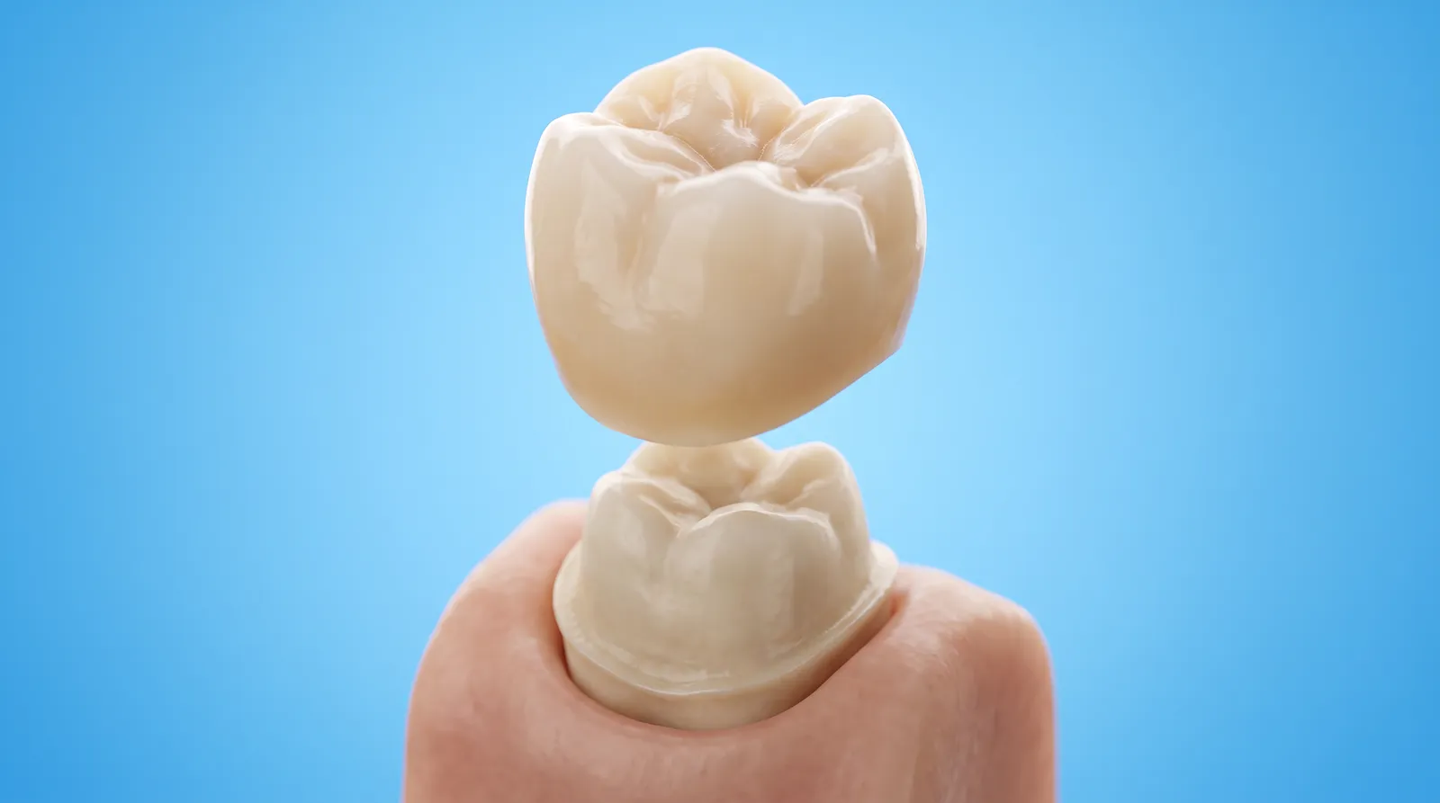 A ceramic crown lowering down over a prepared molar stump, fitting over the whole tooth