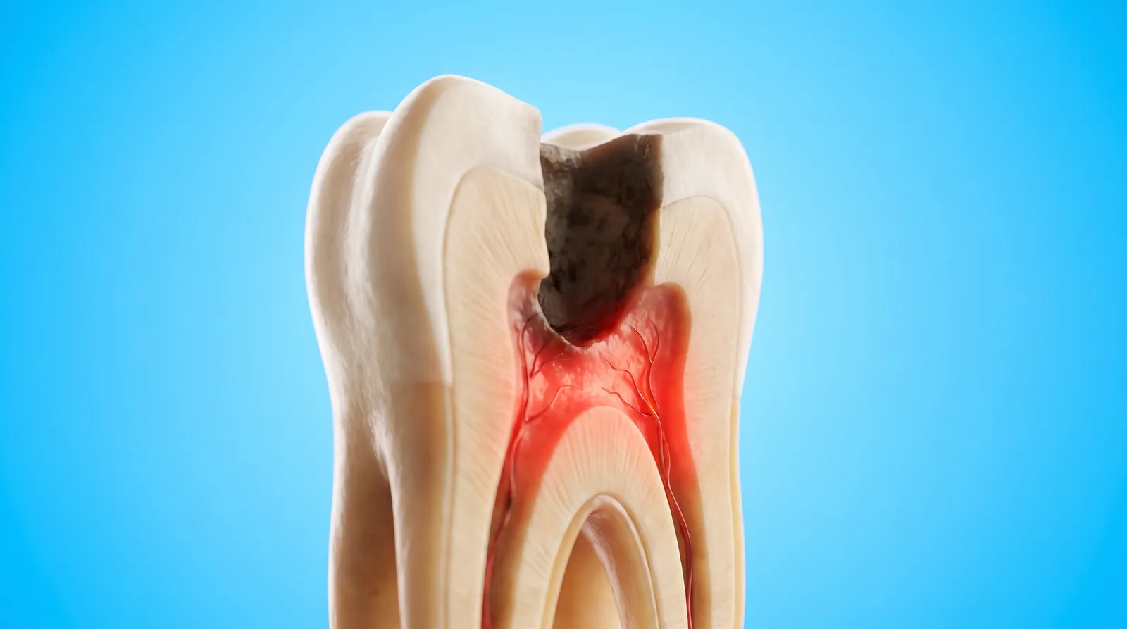 A cut-through molar with a dark cavity reaching down toward an inflamed red nerve chamber