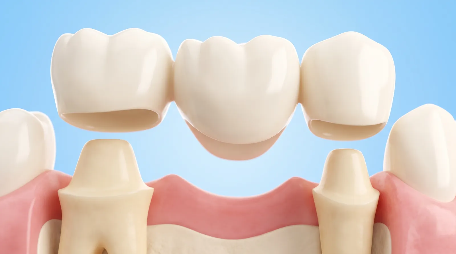 A dental bridge carried by two teeth that have been ground down into pegs