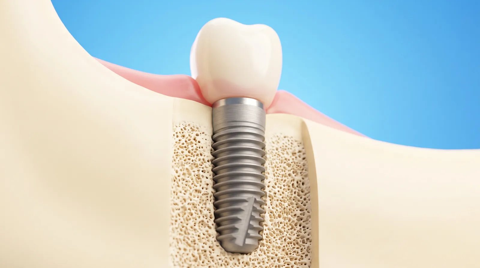 A titanium post threaded into jawbone with a ceramic crown on top of it