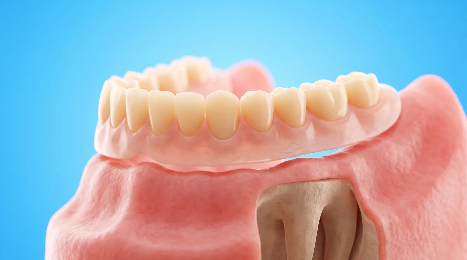 A cut-through of a bare gum ridge with a denture sitting on top of it and no roots beneath