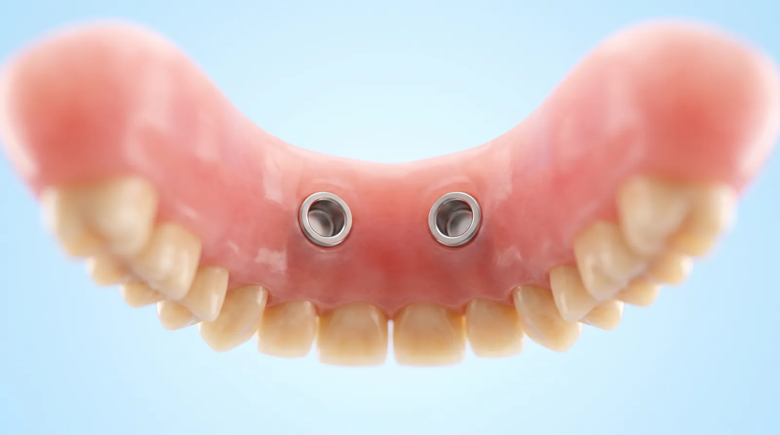 A denture with two round attachment sockets in its base, above two titanium implant posts in a ridge