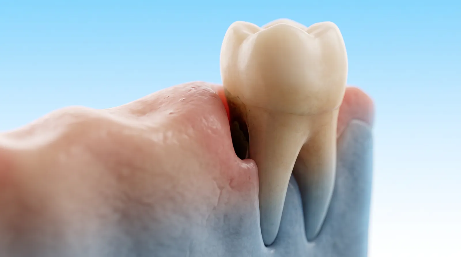A cut-through gum model with the swelling reduced but a dark pocket still beside the tooth