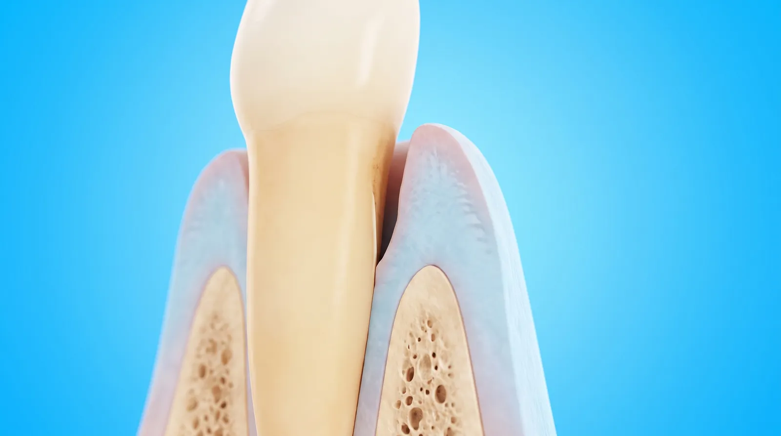 A cut-through showing a deep narrow pocket between the gum and the side of a tooth root