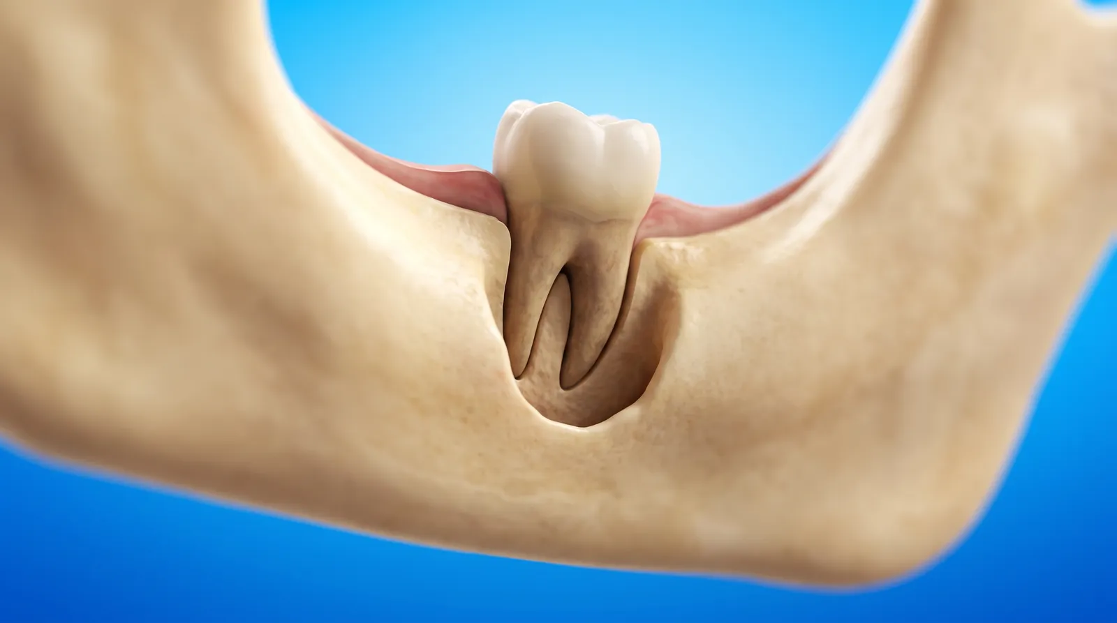 A cut-through jaw showing bone that has receded low down the side of a tooth root