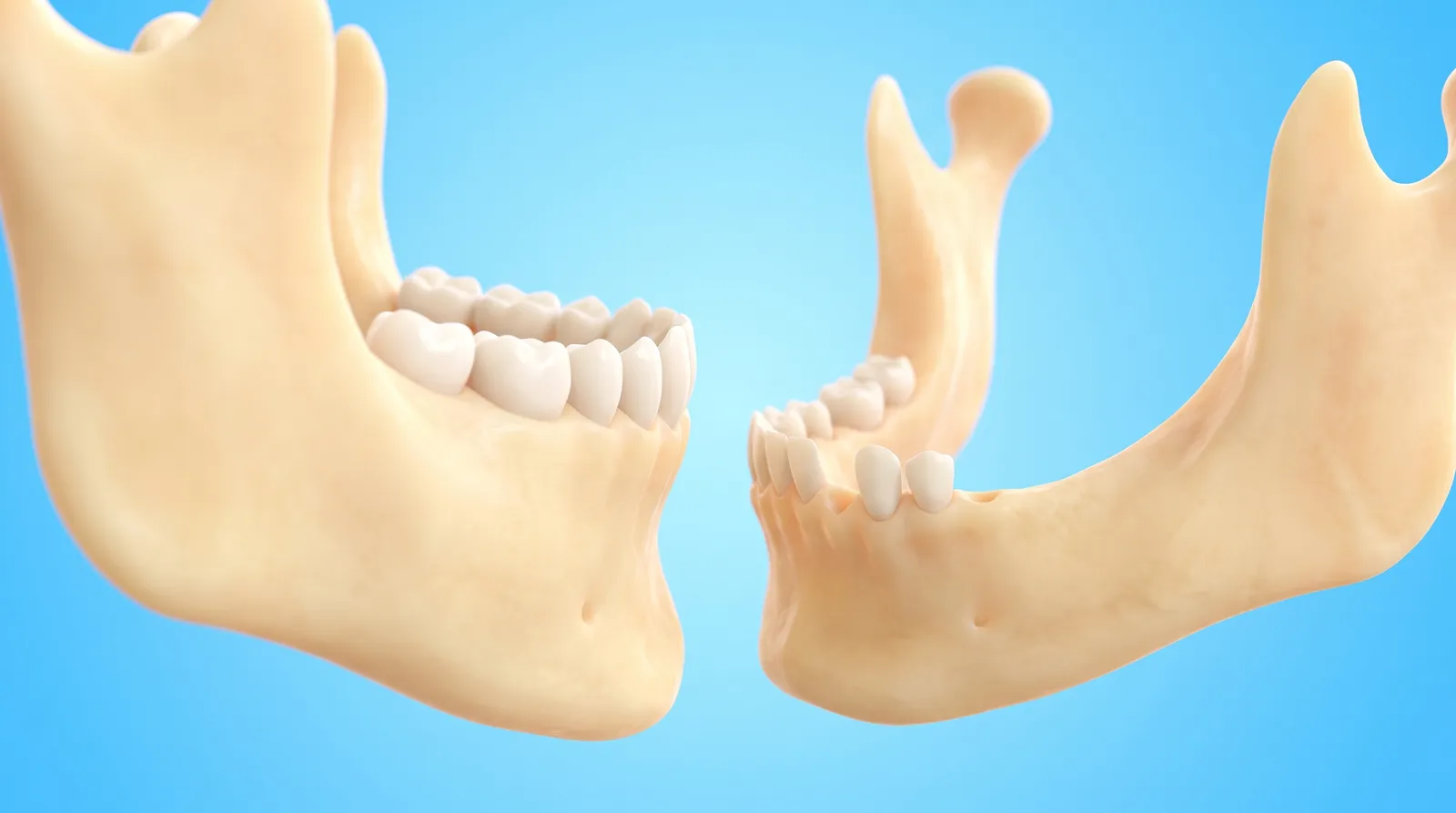 Two cut-through jaw sections side by side, one with high full bone and one with low thin bone