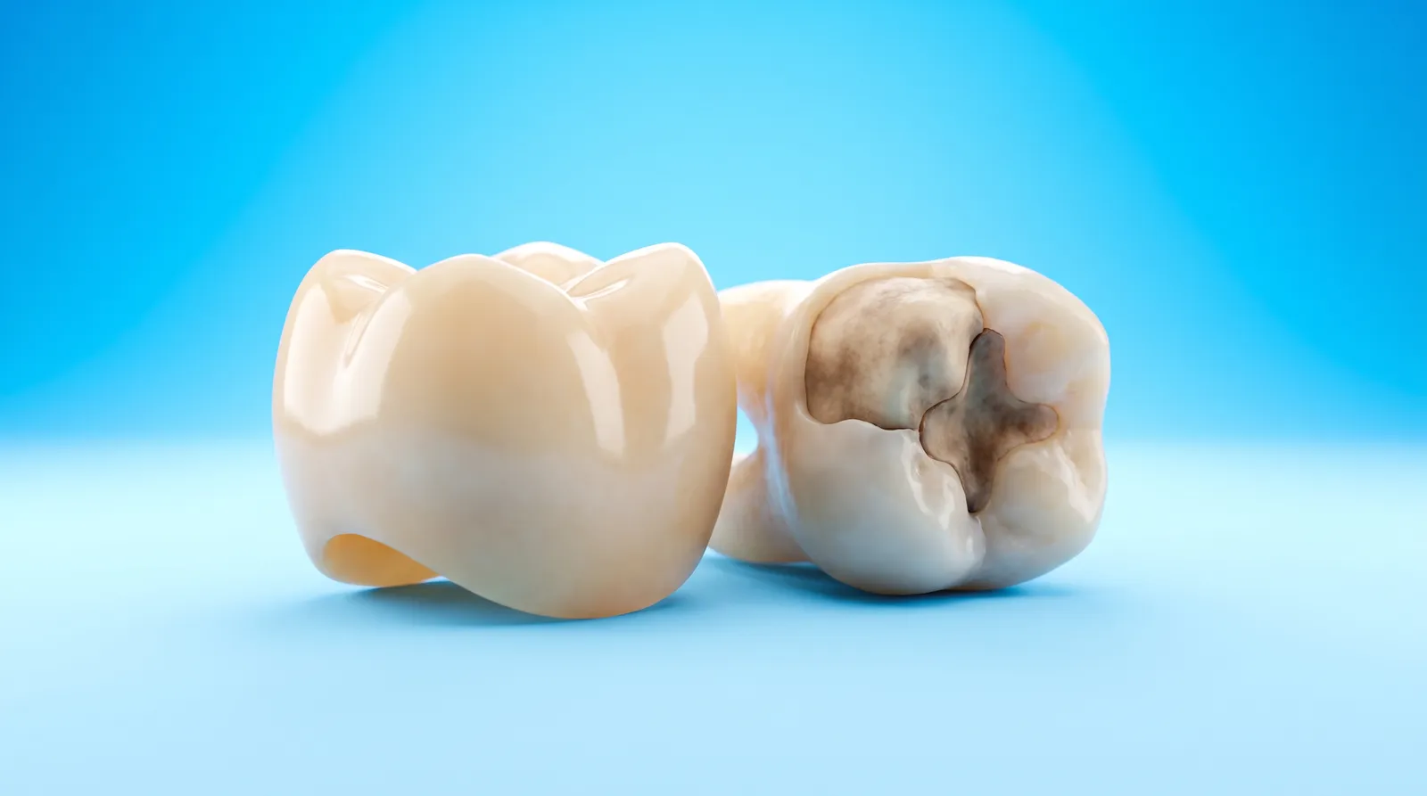 A ceramic crown resting beside a molar, larger than the damaged part of the tooth