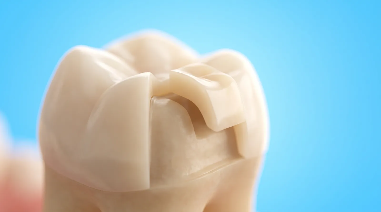 A custom tooth coloured onlay piece fitting precisely into one prepared corner of a molar