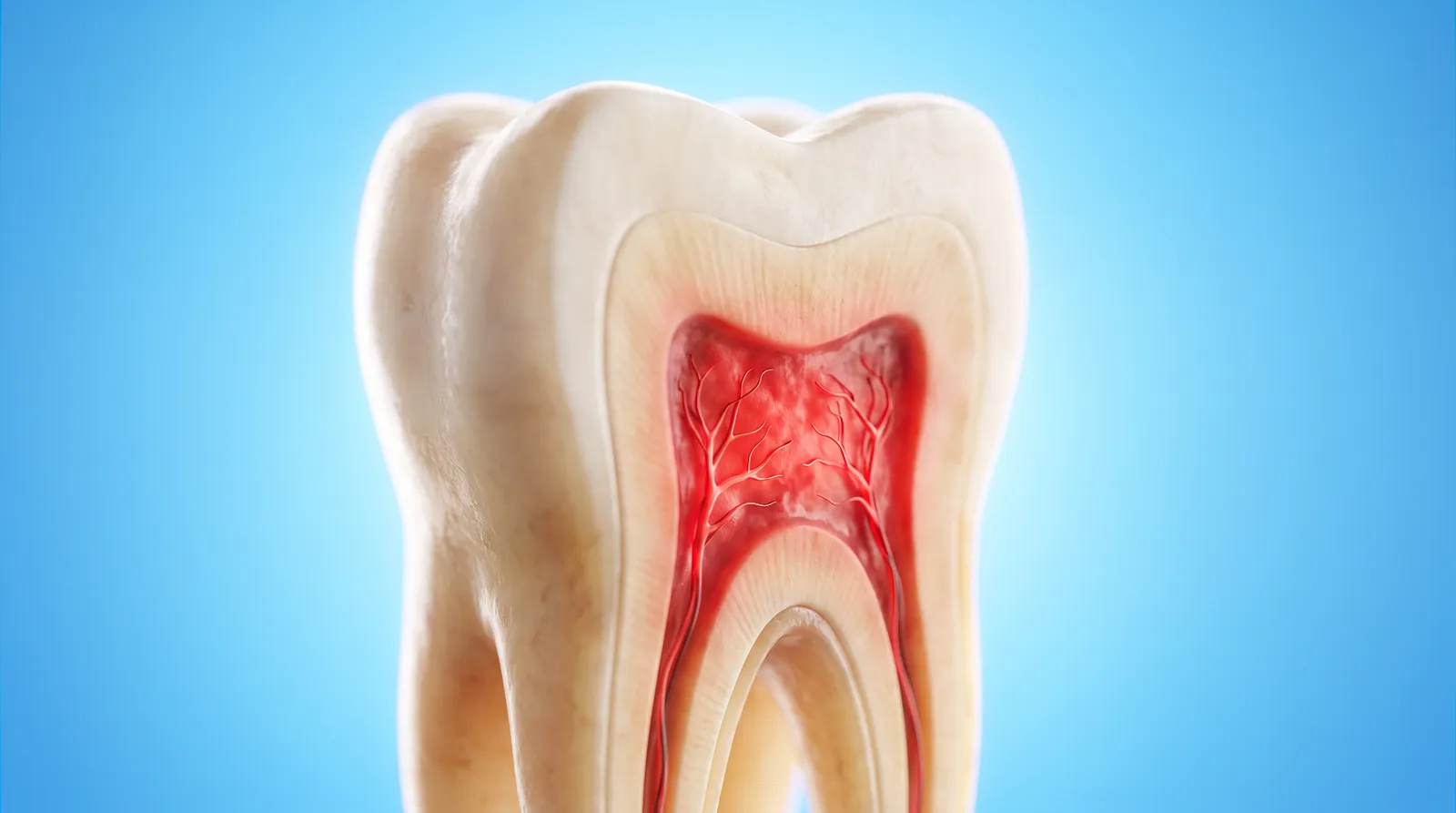A cut-through molar showing an inflamed red nerve chamber deep inside the root