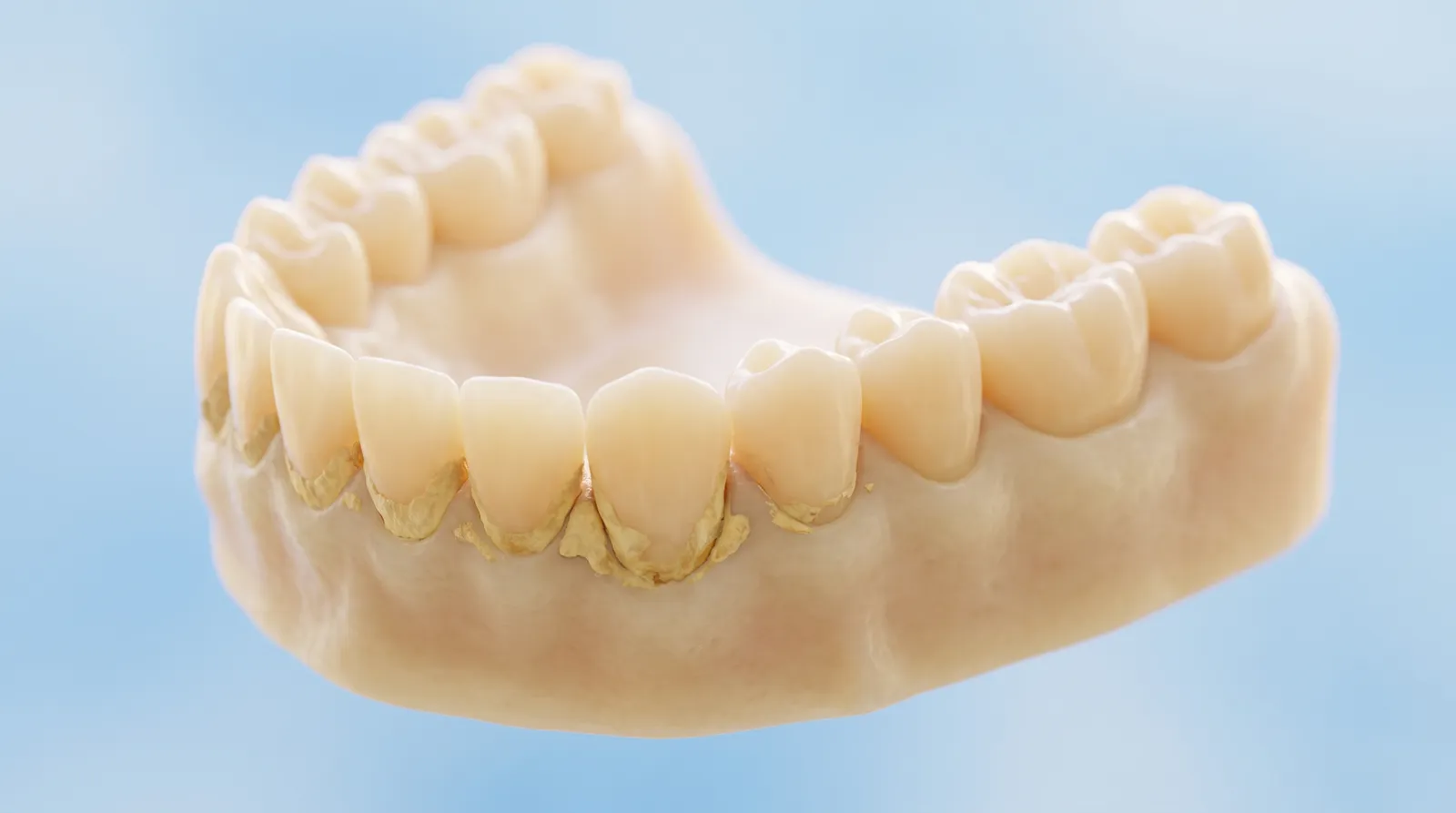 A dental arch model with hard yellow deposits built up along the gum line of the lower front teeth
