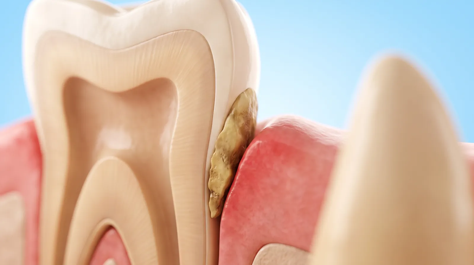 A cut-through showing hard deposit wedged between the gum edge and the side of a tooth
