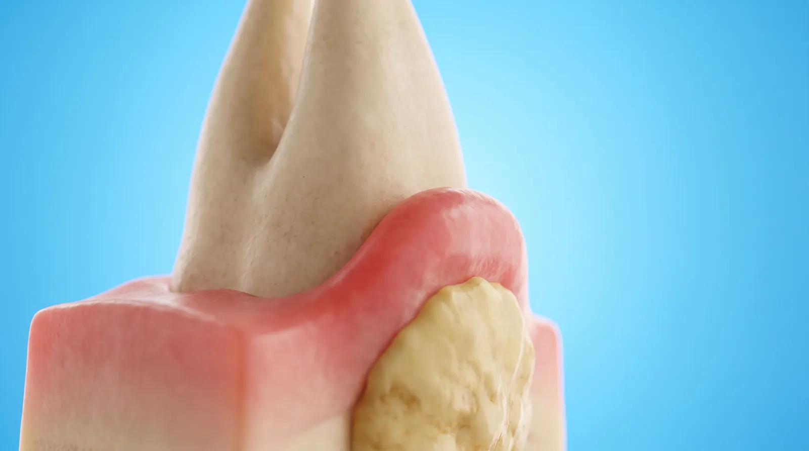 A cut-through gum model with the gum edge red and swollen above a hard deposit