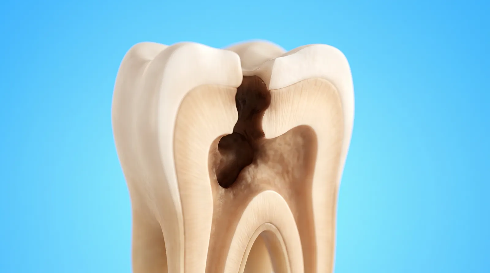A cut-through molar with a large dark cavity spreading through its middle
