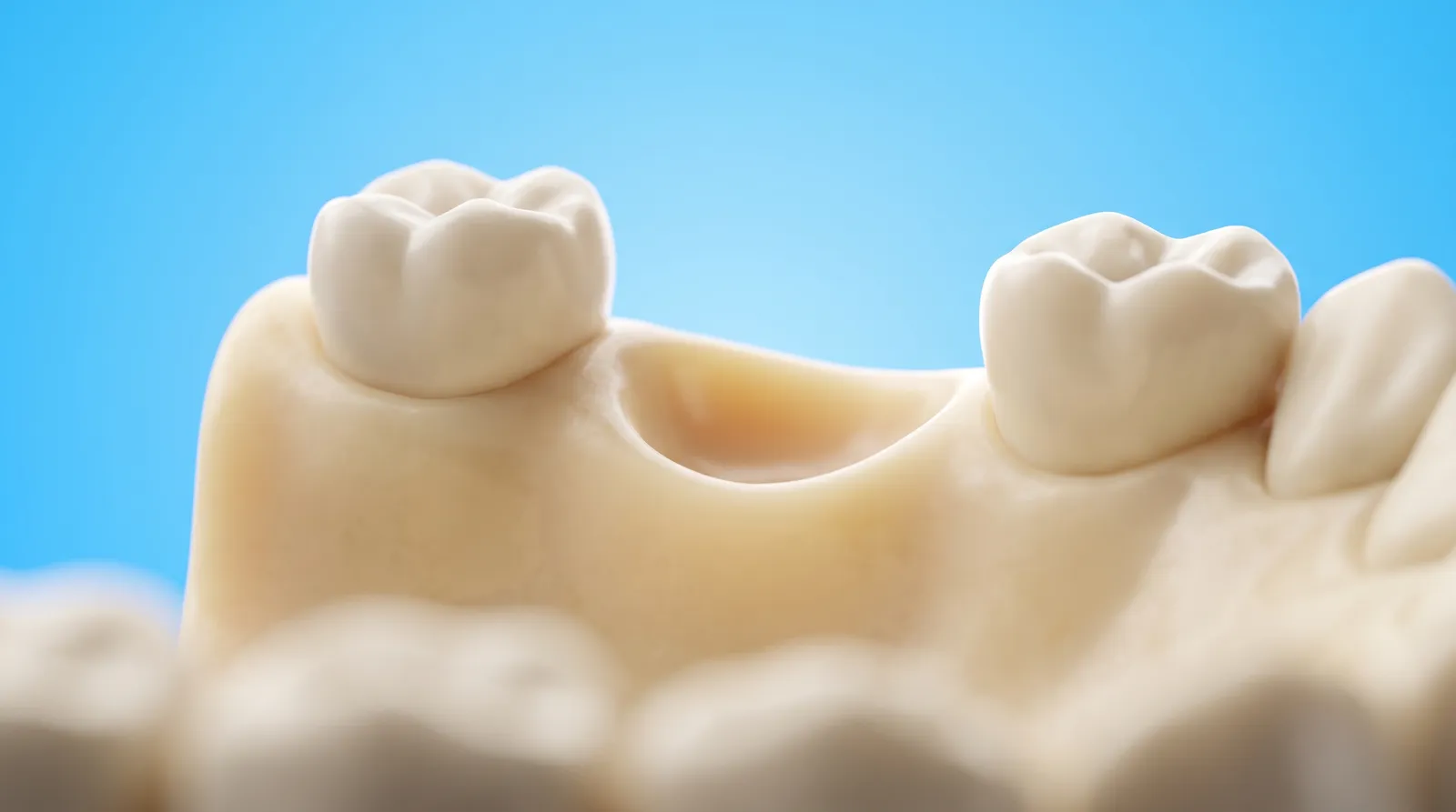 A gum ridge with one clean empty socket between two standing teeth