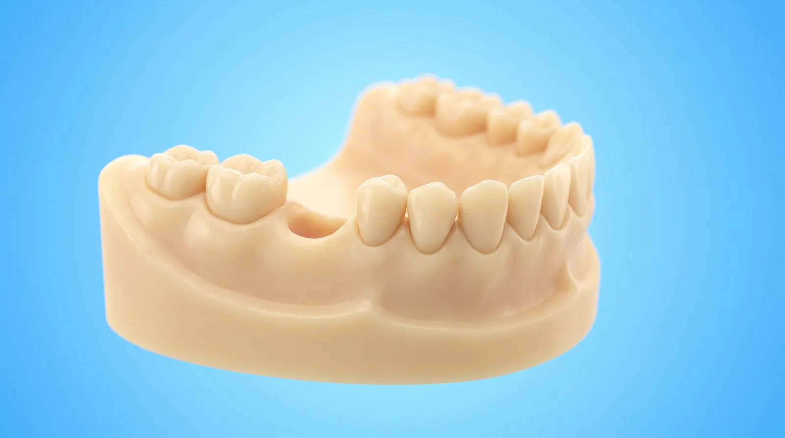 A dental arch with a gap where a tooth is missing and the teeth either side leaning into the space