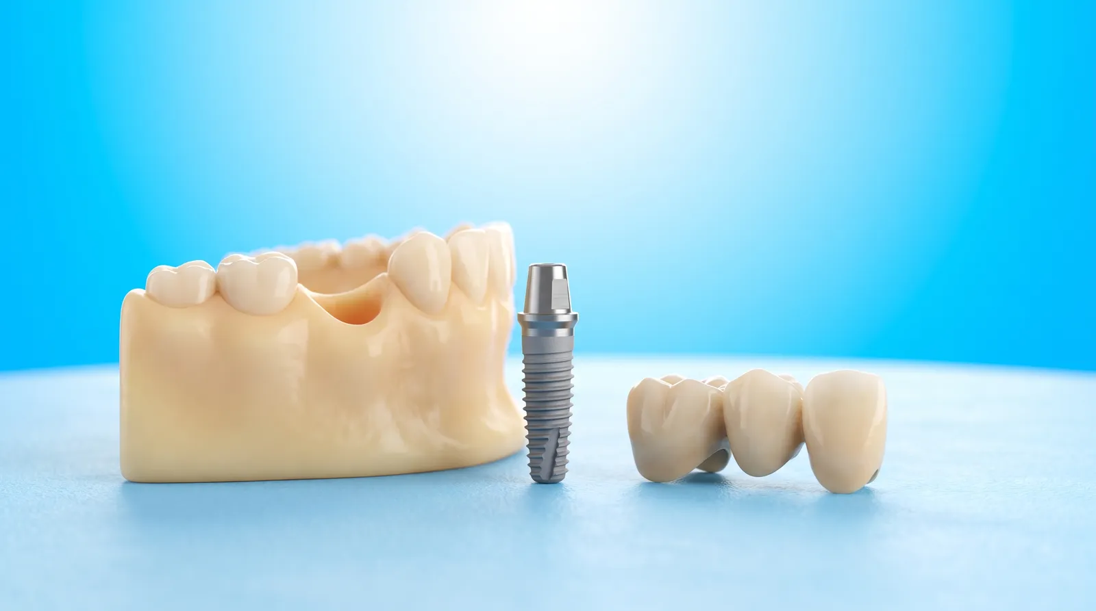 A gum ridge with an empty socket beside a titanium implant post and a bridge, laid out as options