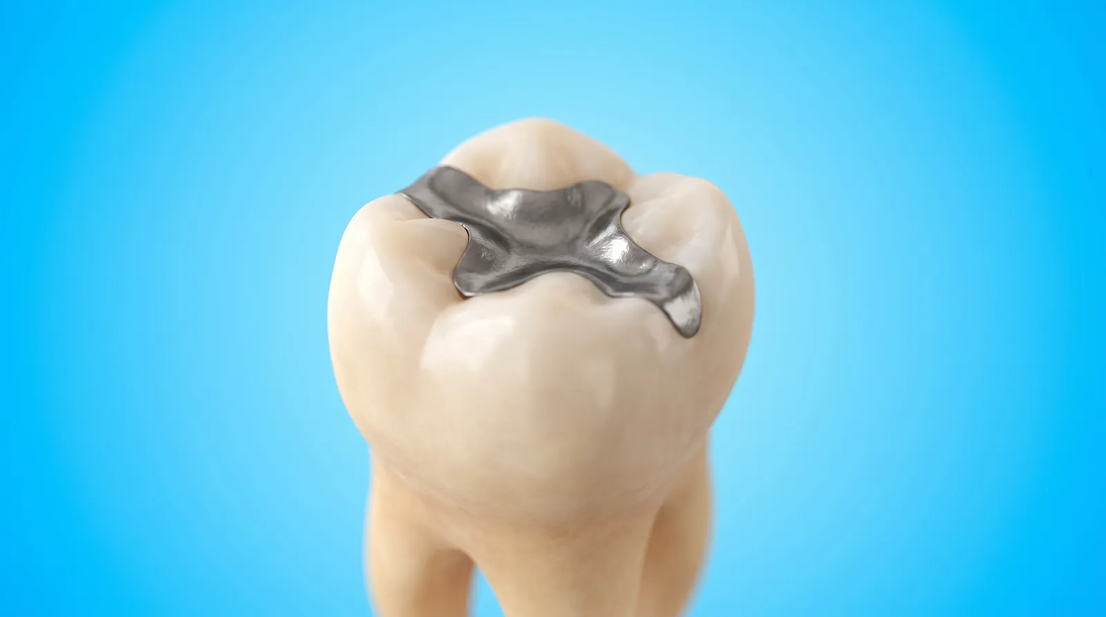 A lower molar with a large dark silver coloured filling in its biting surface